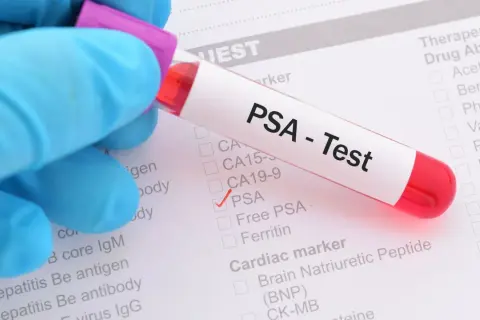 Probówka z krwią do testu PSA na tle formularza medycznego z zaznaczoną opcją PSA.