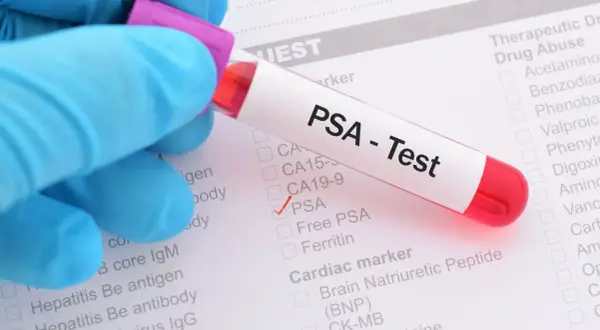 Probówka z krwią do testu PSA na tle formularza medycznego z zaznaczoną opcją PSA.