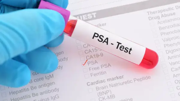 Probówka z krwią do testu PSA na tle formularza medycznego z zaznaczoną opcją PSA.